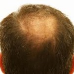 hair transplant 150x150 Cosmetic Surgery Advantages Manifold