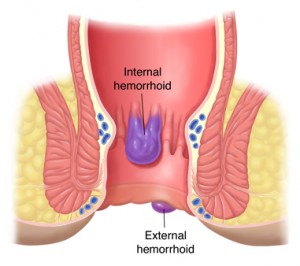 hemorrhoids